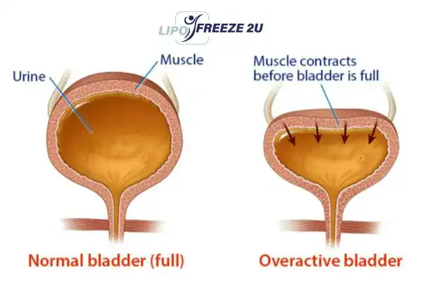 diagram of overactive bladder treatment Royal Wootton Bassett