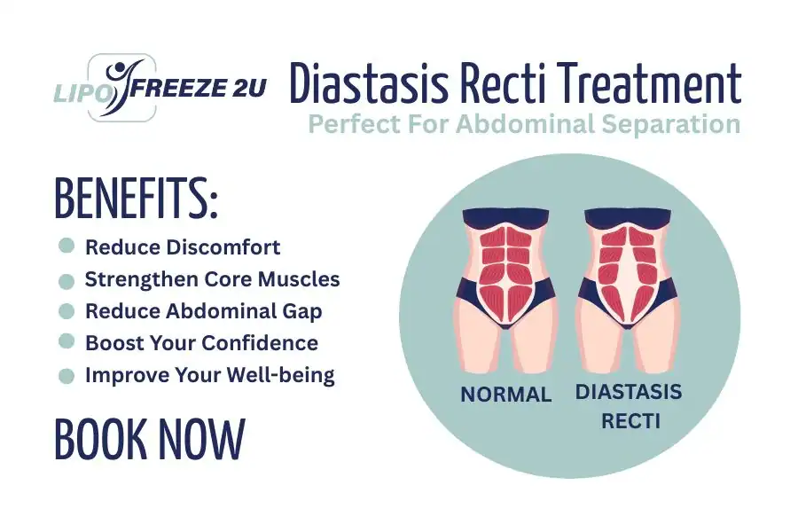 How Long Will It Take to See Improvements in Diastasis Recti Royal Wootton Bassett