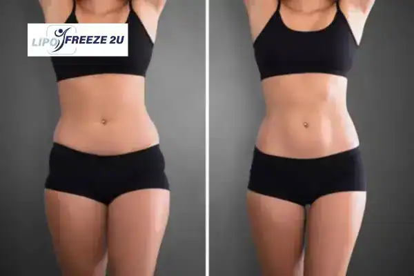 How Can LIPO FREEZE 2U Support Your Post-Pregnancy Body Recovery Royal Wootton Bassett?
