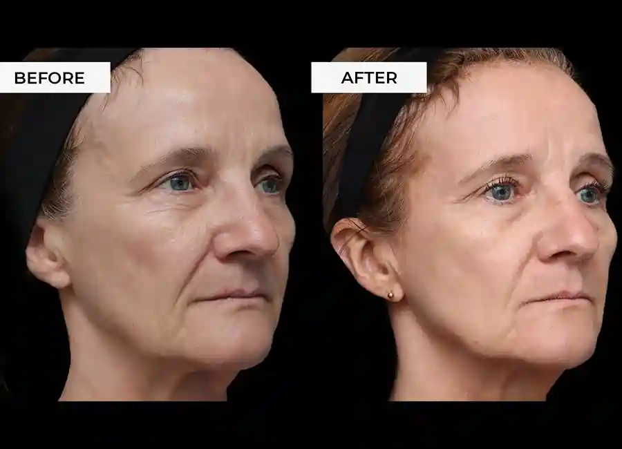 How Many RF Microneedling Sessions Will You Need to See a Difference Royal Wootton Bassett?