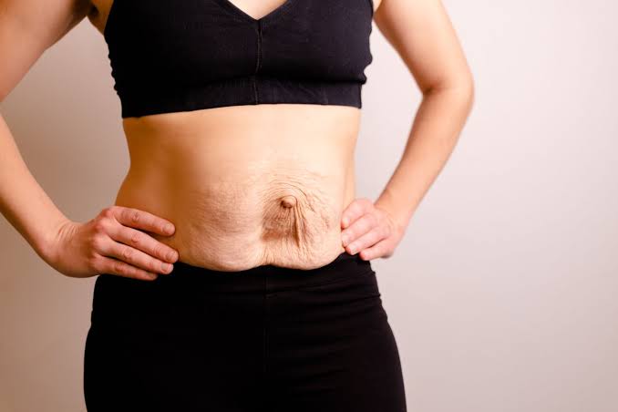 Is Surgery Really the Only Way to Repair Diastasis Recti Royal Wootton Bassett?