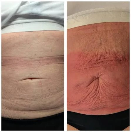 How Does RF Microneedling Improve Crepey, Thin and Uneven Skin Texture Royal Wootton Bassett?