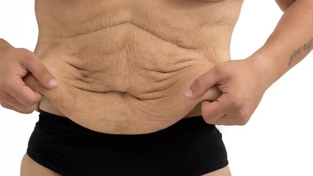 RF Microneedling for Loose Skin: How Can It Help Tighten and Reshape the Skin Royal Wootton Bassett?